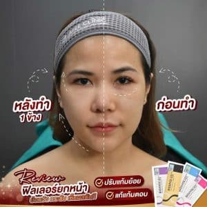 รีวิวfillerใต้ตา02