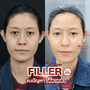 รีวิวfillerใต้ตา04