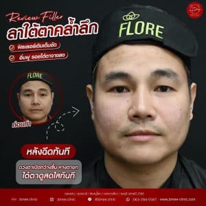 รีวิวfillerใต้ตา05