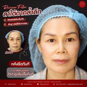 รีวิวfillerใต้ตา06