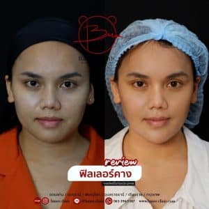 รีวิวฟิลเลอร์คาง01