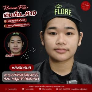 รีวิวฟิลเลอร์คาง02