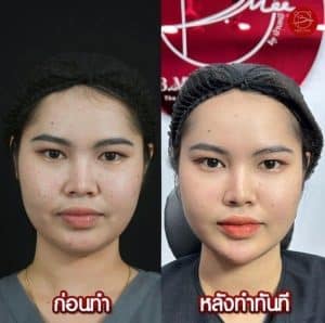 เสริมคาง