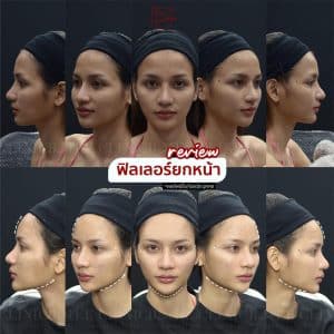 รีวิวฟิลเลอร์ปรับรูปหน้า01