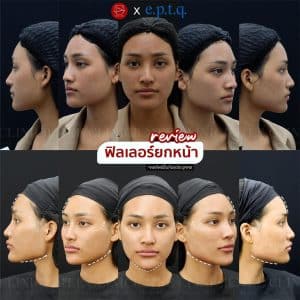 รีวิวฟิลเลอร์ปรับรูปหน้า02