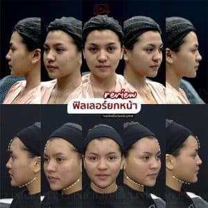 รีวิวฟิลเลอร์ปรับรูปหน้า03