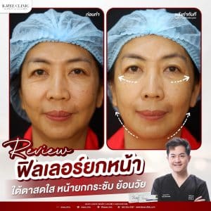 รีวิวฟิลเลอร์ปรับรูปหน้า05