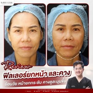 รีวิวฟิลเลอร์ปรับรูปหน้า06