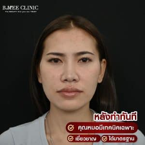 รีวิวฟิลเลอร์ปรับรูปหน้า07