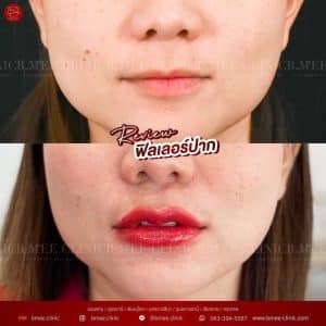 รีวิวฟิลเลอร์ปาก01