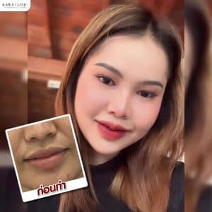 รีวิวฟิลเลอร์ปาก03