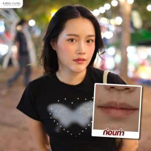 รีวิวฟิลเลอร์ปาก04