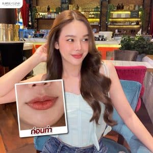 รีวิวฟิลเลอร์ปาก05