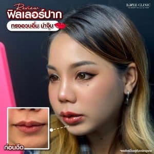 รีวิวฟิลเลอร์ปาก06