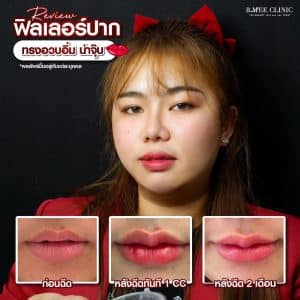 รีวิวฟิลเลอร์ปาก07