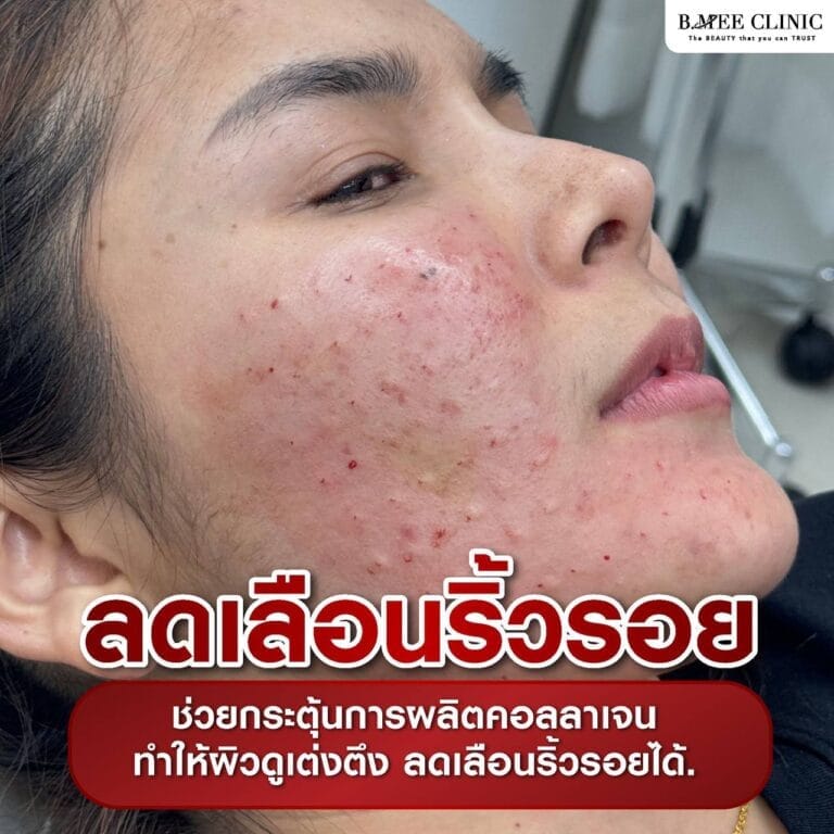 เมโสหน้าใส Info 4