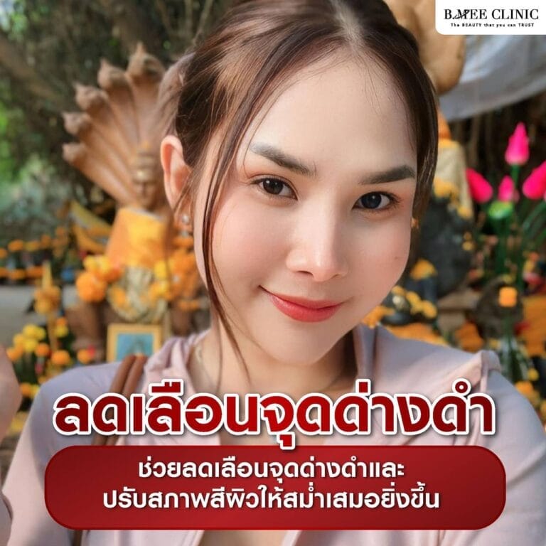 เมโสหน้าใส Info 3