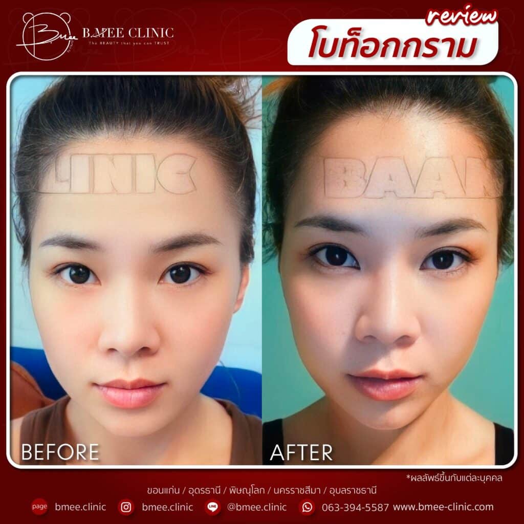 รีวิว Botox 6