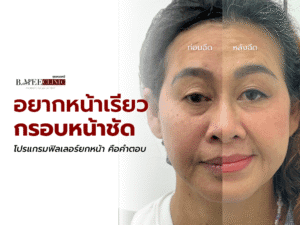 ฟิลเลอร์ยกหน้า