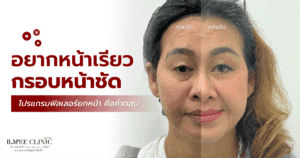 บทความ ฟิลเลอร์ยกหน้า