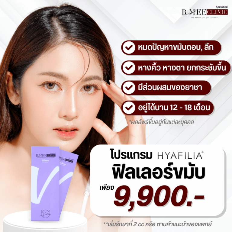 โปรโมชั่น ฟิลเลอร์ขมับ Hyafilia