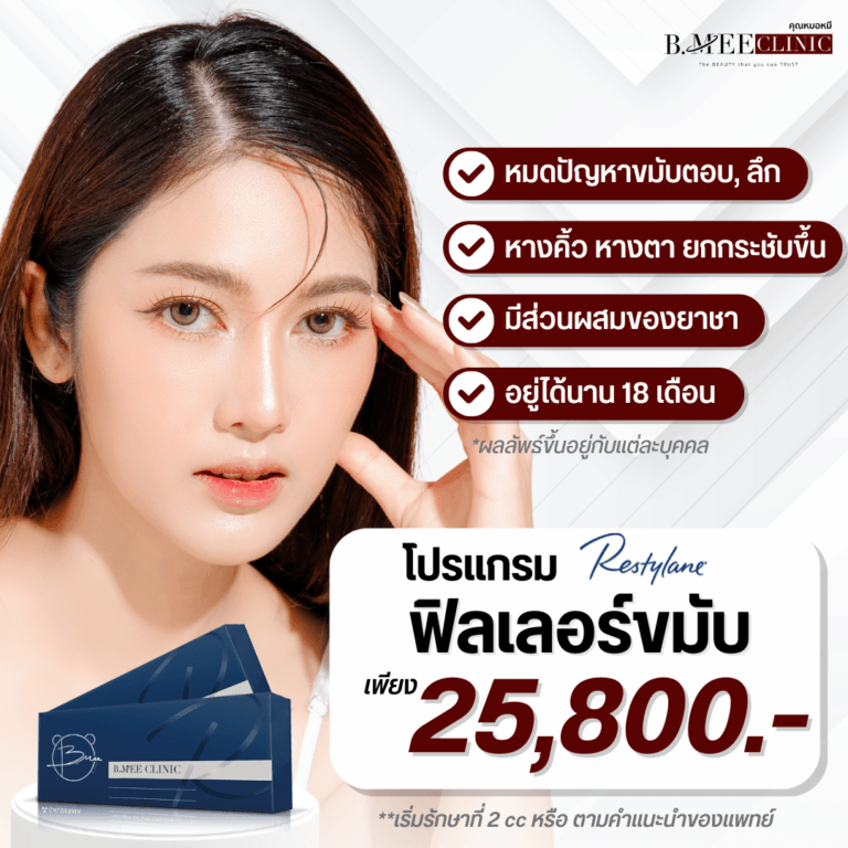 โปรโมชั่น ฟิลเลอร์ขมับ Restylane