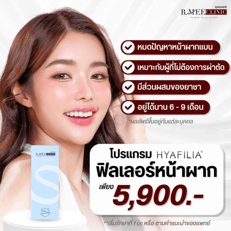 โปรโมชั่น ฟิลเลอร์หน้าผาก Hyafilia