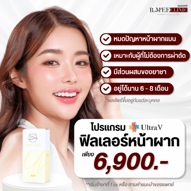 โปรโมชั่น ฟิลเลอร์หน้าผาก Ultra V
