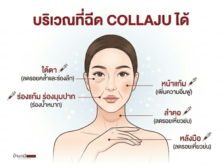 ภาพอธิบายตำแหน่งที่สามารถฉีด Collaju บนใบหน้า ลำคอ และหลังมือ เพื่อแก้ปัญหาริ้วรอยและร่องลึก