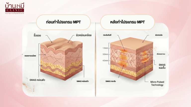 ก่อนและหลังการทำ MPT