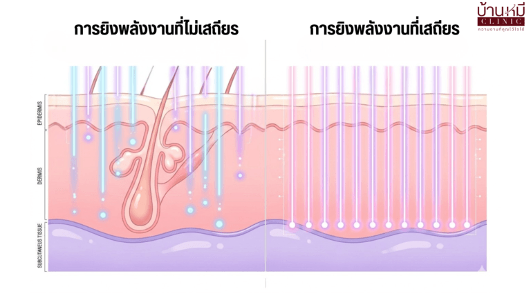 การยิงพลังงานของเครื่อง MPT